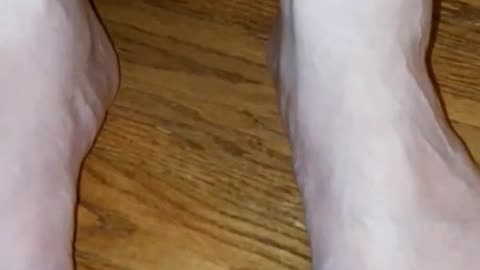 Lyme Disease - Mar 2025 - Swollen legs and feet