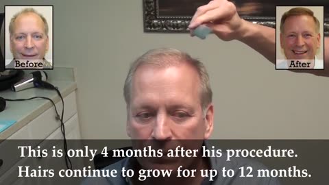 Dr. Brett Bolton: Flawless, Undetectable Hair Transplant Scar