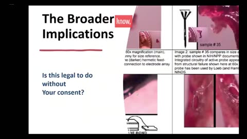 Confirmed Implant Removed: Bonnie Kellerby’s Shocking RF Scan & Lab Report | Jesse Beltran