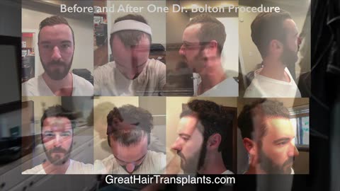 Dr. Brett Bolton FUE/Robotic ARTAS Correction – Casey Short Testimonial