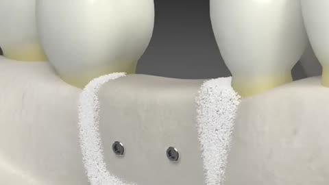 Dental Bone Graft