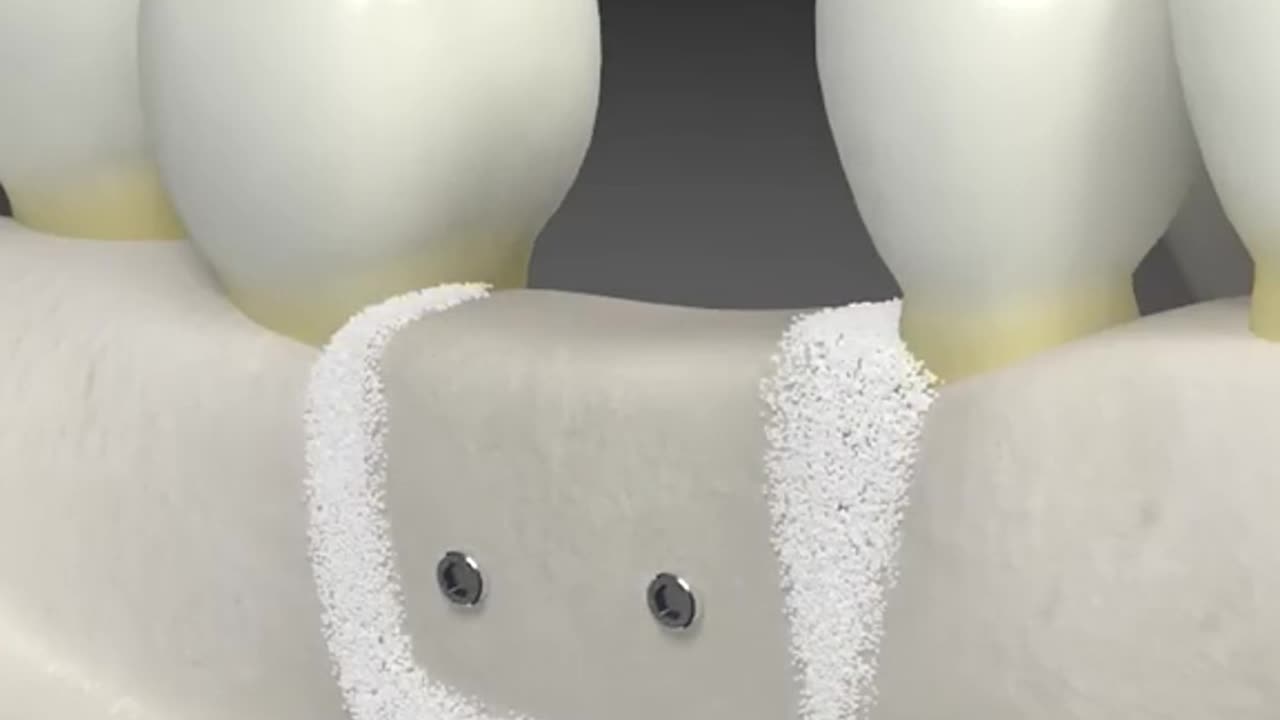 Dental Bone Graft