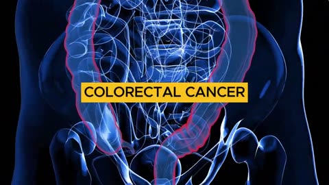 8 Super Foods to Prevent Bowel Cancer & Colon Polyps