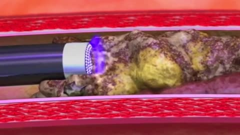 How Laser Atherectomy Procedure Is Performed (3D Animation)