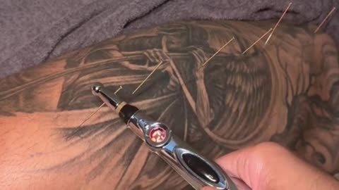 applying electro stimulus to dry needles