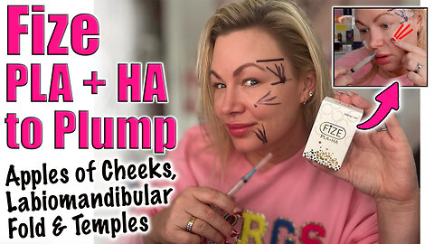 Plump Apples of Cheeks, Labiomandibular Fold & Temples with Fize PLA + HA! Code Jessica10