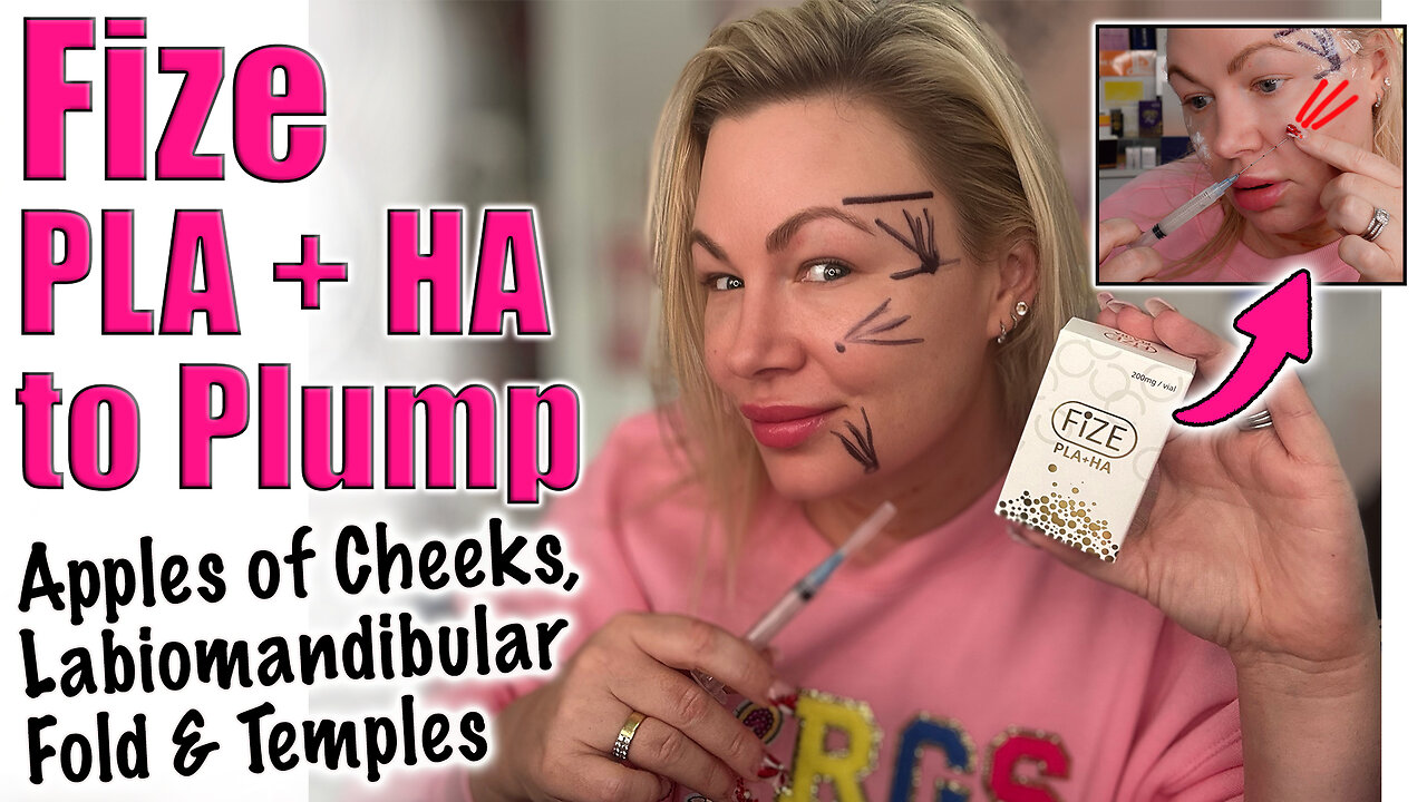 Plump Apples of Cheeks, Labiomandibular Fold & Temples with Fize PLA + HA! Code Jessica10