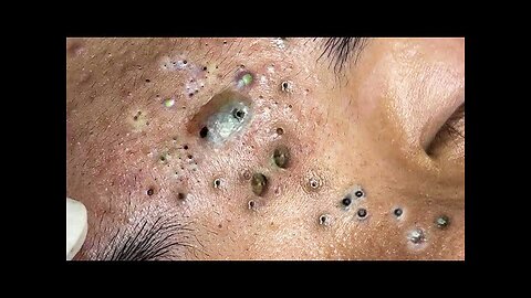 Blackheads Removal & Pimple Popper Cystic Acne Extraction 3