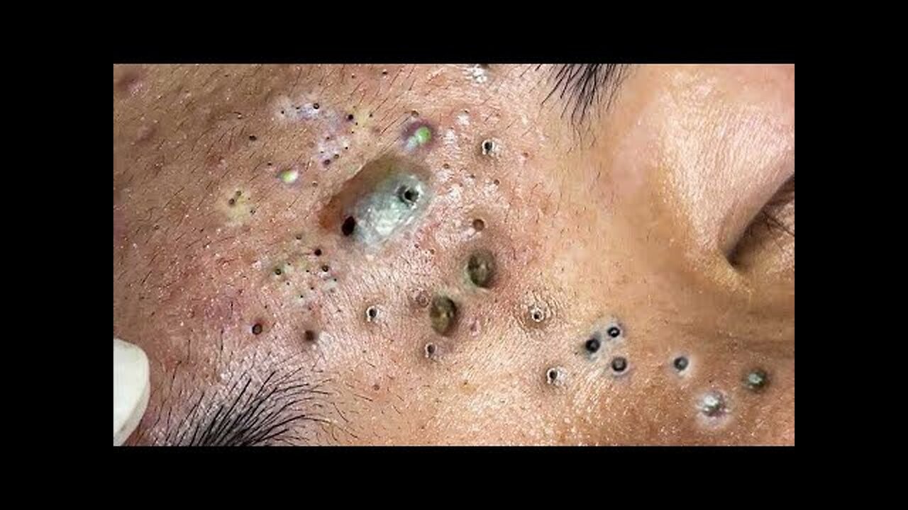 Blackheads Removal & Pimple Popper Cystic Acne Extraction 3