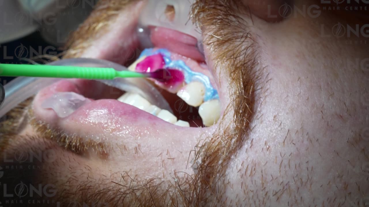 Combine your hair transplant journey with dental treatment at Long Hair Centre.