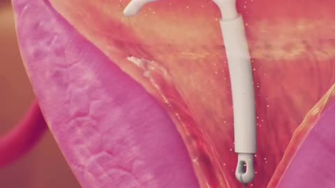 How Intrauterine Device (IUD) Is Inserted And How It Works