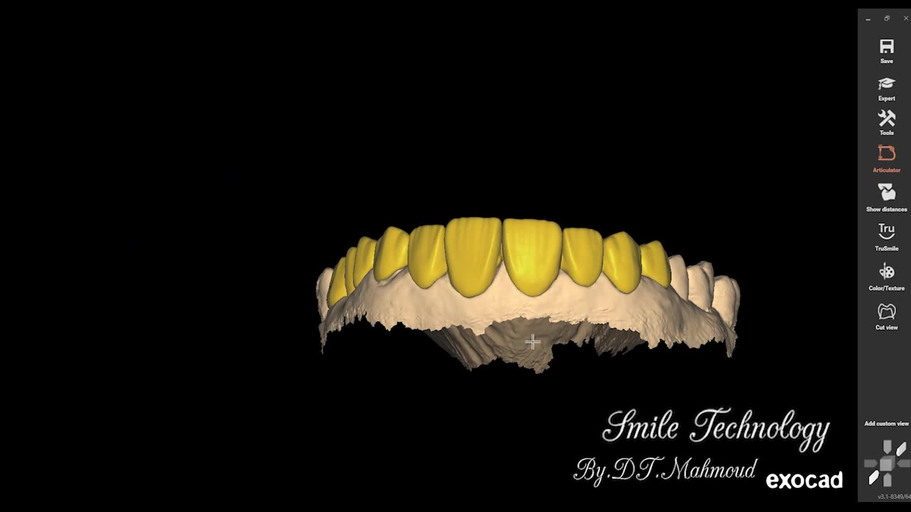 #design #naildesign #dental #dentaldesign #exocadexpert