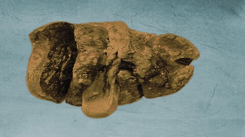 A Student Ate 5 Day Old Pasta For Lunch. This Is What Happened To His Liver.