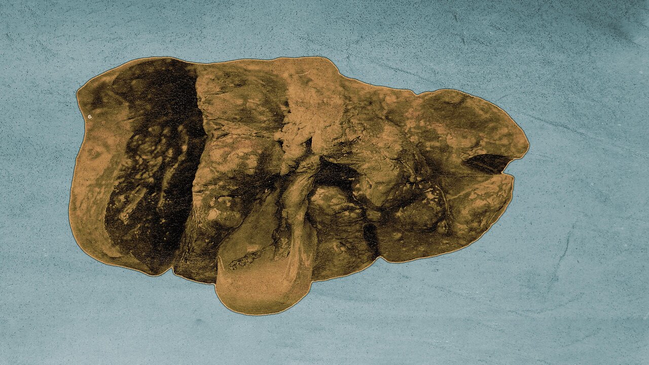 A Student Ate 5 Day Old Pasta For Lunch. This Is What Happened To His Liver.