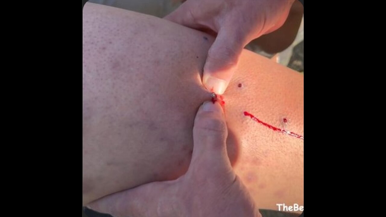 Metal BB Zit Popping Pain Challenge!!!