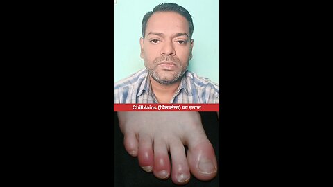 Chilblains (चिलब्लेन्स) का इलाज ।