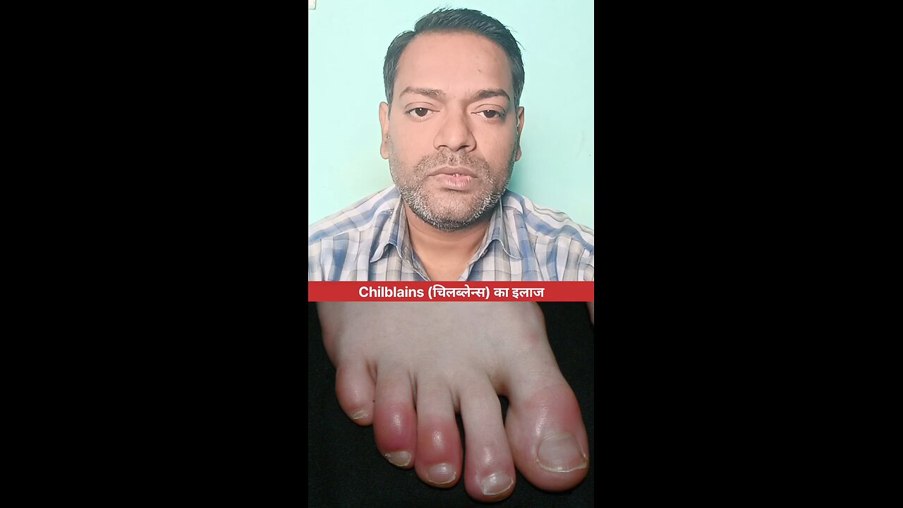 Chilblains (चिलब्लेन्स) का इलाज ।