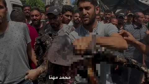 Gaza children are burning (Graphic warning)