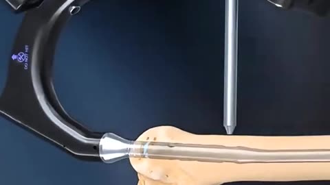 Broken Thigh Bone Here’s How Surgeons Fix a Femur Fracture Step-by-Step!