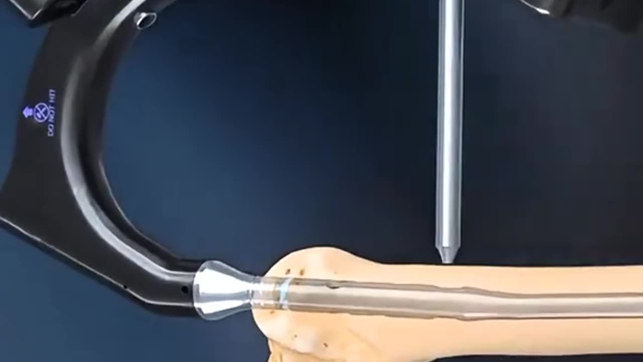 Broken Thigh Bone Here’s How Surgeons Fix a Femur Fracture Step-by-Step!