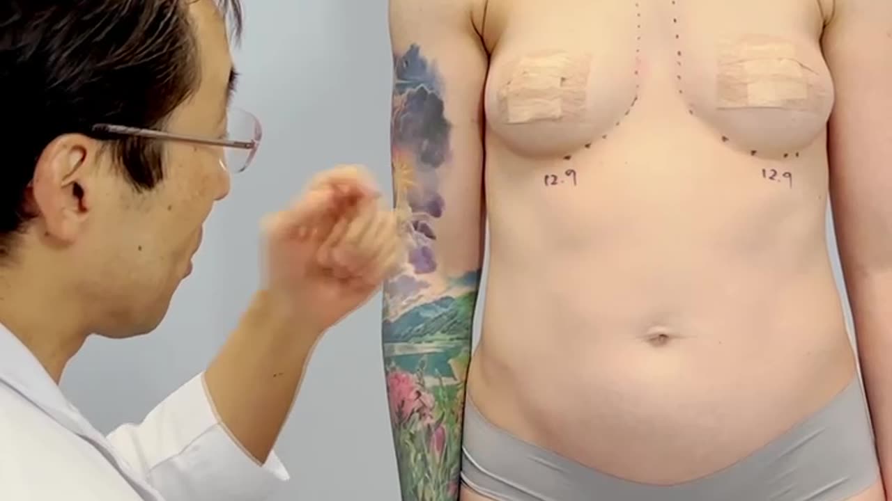 Awake Breast Augmentation: Achieving the Perfect Size & Shape with Real-Time Adjustments