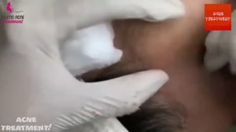 Blackheads Removal & Pimple Popper Cystic Acne Extraction 216