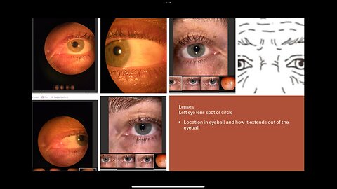 Ai Assimilation- Eyeball Sunburn UV light to lens in left eyeball