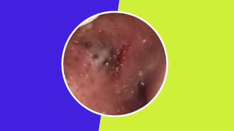 Skincare | Blackheads Removal (ASMR) #5 #tweezers #skincare #blackheads