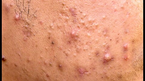 All Collect Videos Dr.Pimple Popper