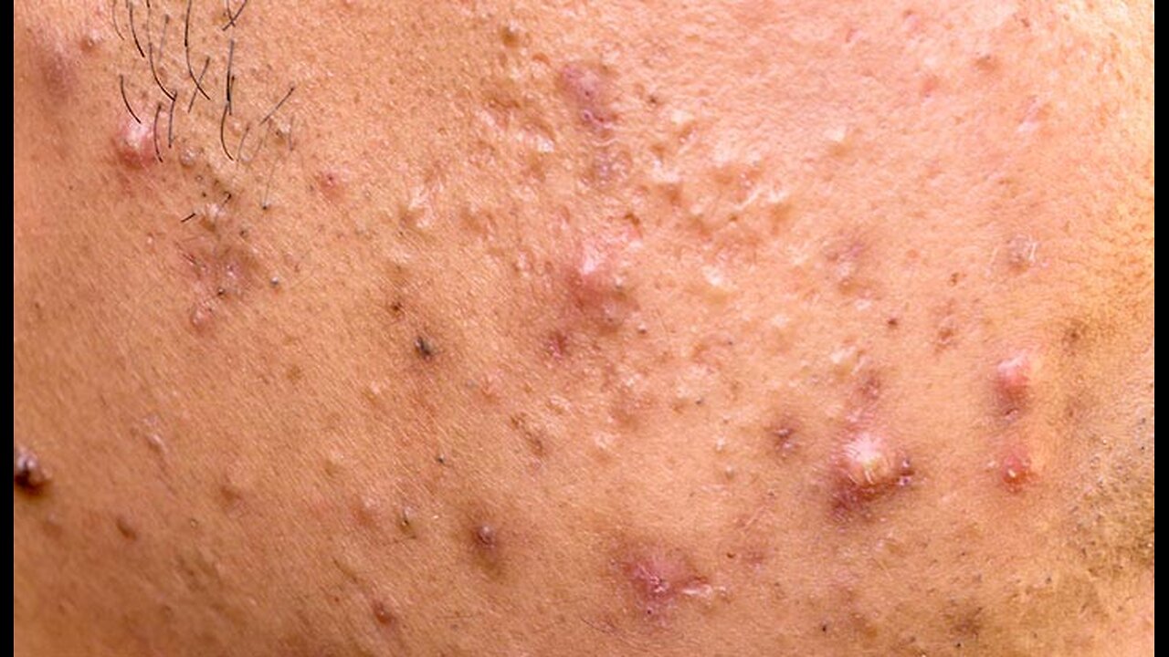 All Collect Videos Dr.Pimple Popper