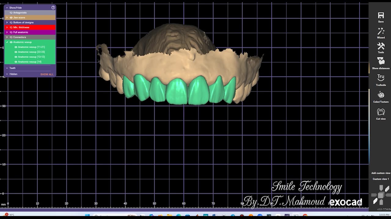 #design #naildesign #dental #dentaldesign #exocadexpert