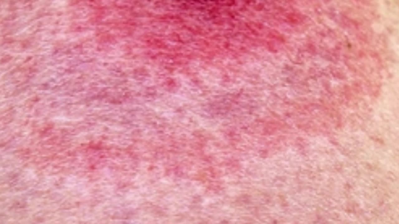 Justin Timberlake’s Honest Confession About Lyme Disease on Tour