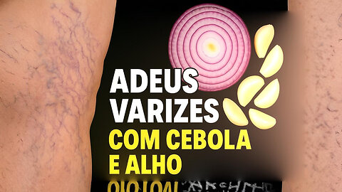 SEGREDO das AVÓS que APAGA VARIZES em 21 DIAS! (Você tem em casa!)