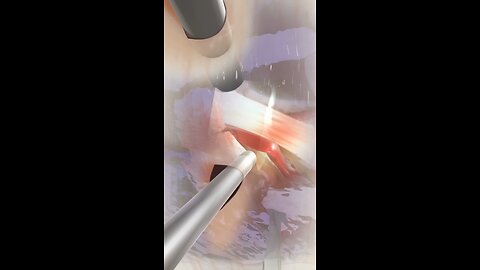 Wrist Arthroscopy ( 3D Animation )