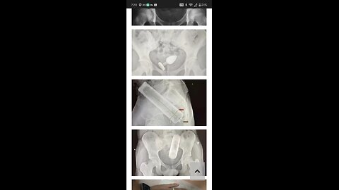 Woman versus MRI machine