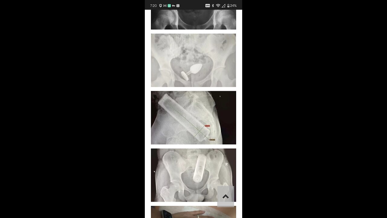 Woman versus MRI machine