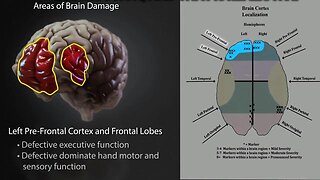 mRNA "vaccines" function as chemical lobotomies - SEVERE brain damage & DEVASTATING mental health
