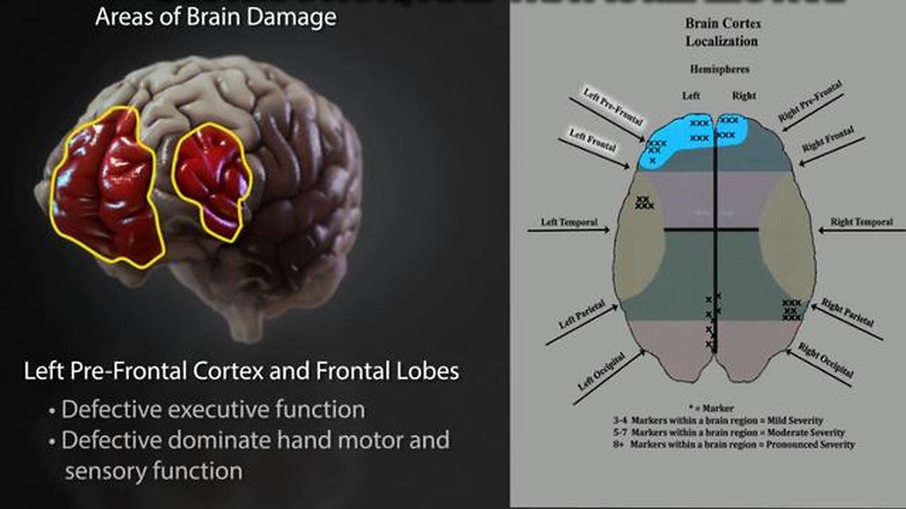 mRNA "vaccines" function as chemical lobotomies - SEVERE brain damage & DEVASTATING mental health