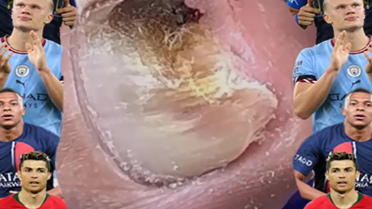 Ingrown Toenail Removal 2023 #ingrowntoenail #toenails #ingrown (3)