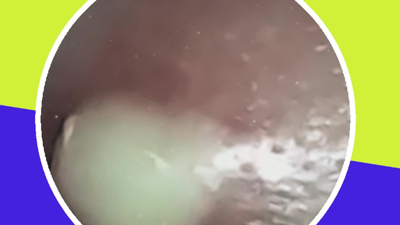 Pimple removal satisfying video (ASMR) #4 #shorts