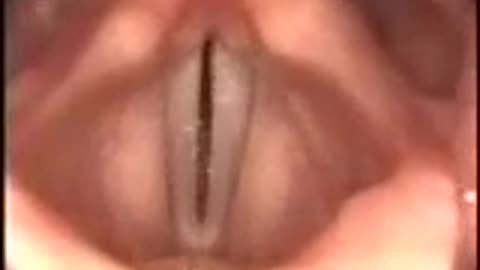 Stroboscopy: Rigid: Normal female vocal cords mid-range