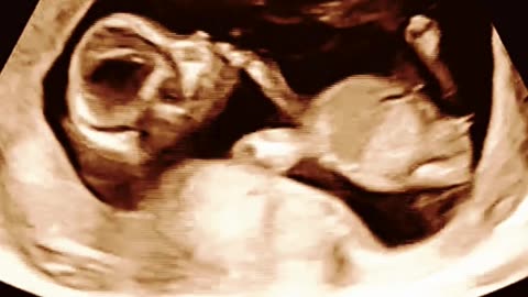 Empowering Parenthood: IVF Excellence at Sumathi Hospital