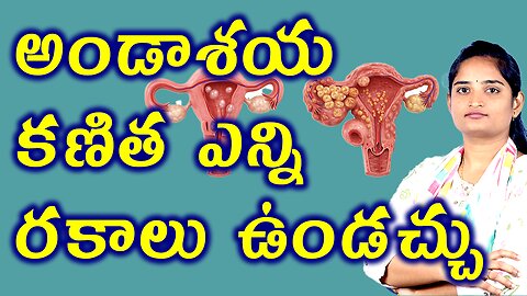 అండాశయ కణిత ఎన్ని రకాలు ఉండచ్చు? How Many Types Of Cyst In Ovary Homeopathy Treatment Medicine Cure
