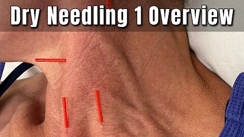 Dry Needling Courses for Healthcare Providers