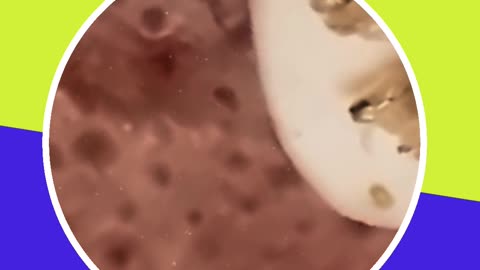 Blackhead removal new this week (ASMR) #6 #shorts