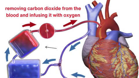 How Does the Heart-Lung Machine Work to Save Lives¿