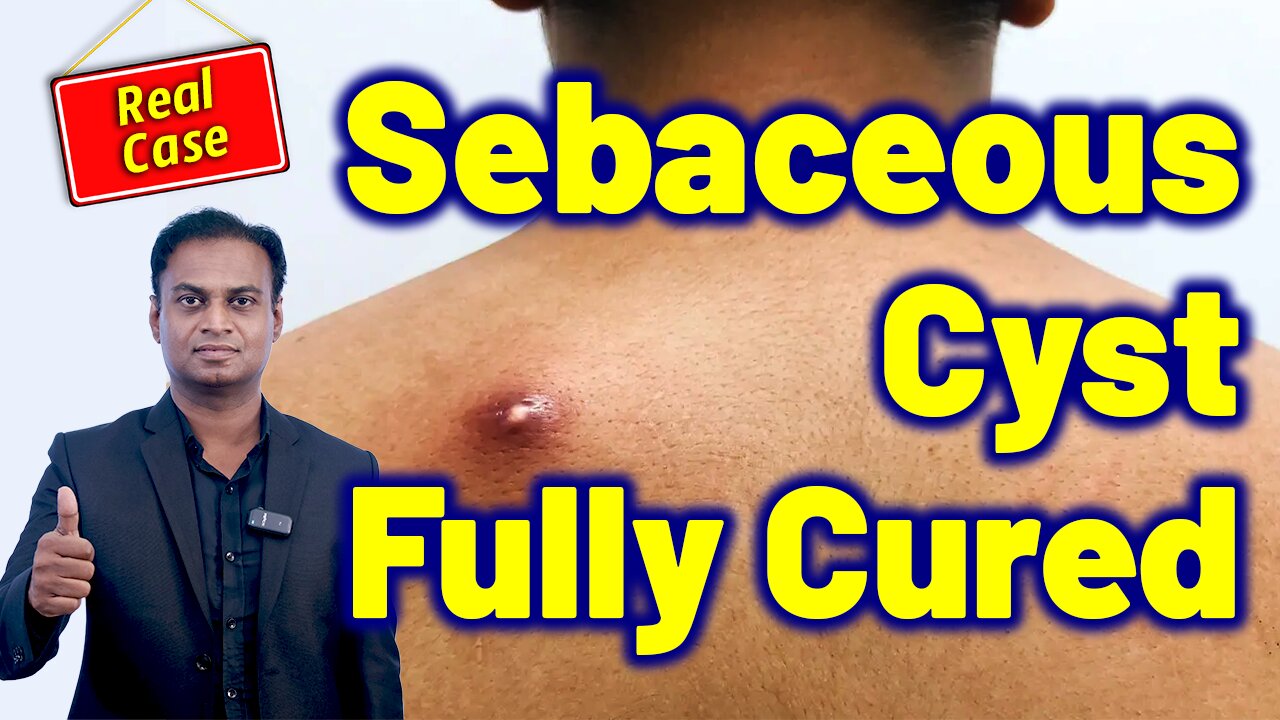 Permanent Treatment for Sebaceous Cyst Without Surgery, Painless Cyst Cure. | Homeopathy .