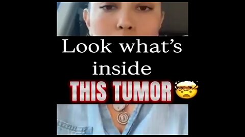 BIG PHARMA IS TRYING TO KEEP THIS A SECRET: TUMORS ARE LIKE PARASITES THAT PLAGUE MUCH OF THE WORLD.