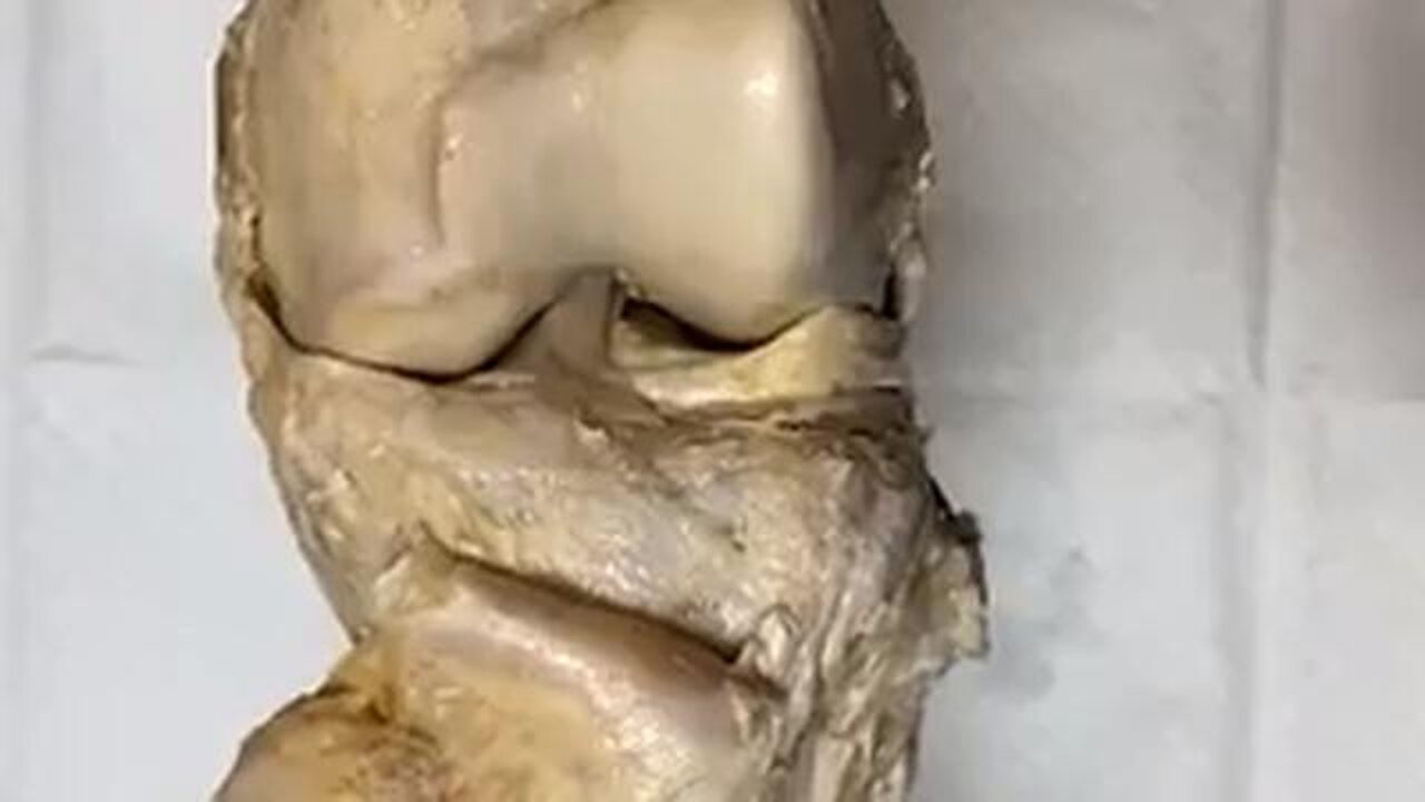 U.S. Joint Specialist : It's Like Hitting Reset on Your Joints