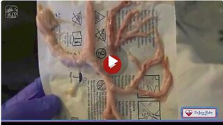 Fibrous Clot |Coughed up by jabbed 32 year old ER patient.